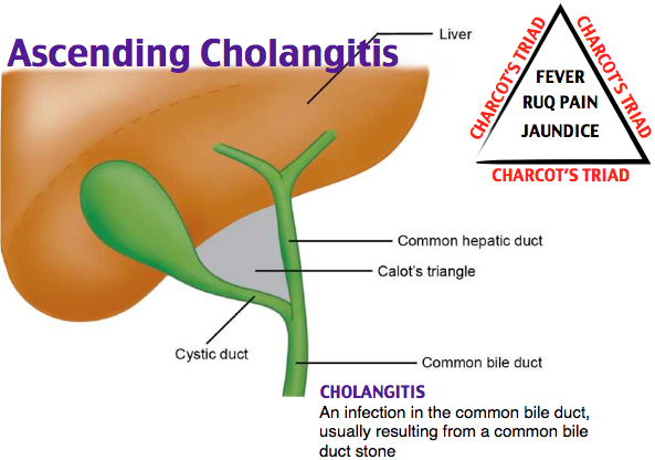 Cholangitis