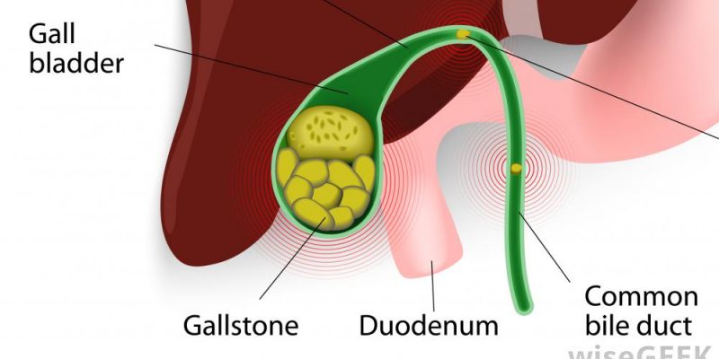 gall-bladder-with-gallstones